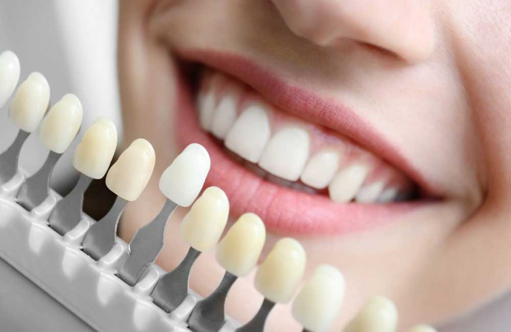 ¿Cómo realizar un buen diseño de sonrisa?